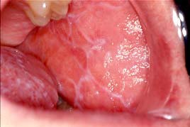 lichen planus vaginal oral cancer Lichen planus vaginal oral cancer